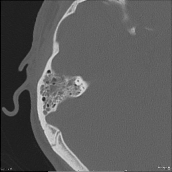 File:Acute otomastoiditis (Radiopaedia 28276-28512 Axial PTB bone window reformat 23).jpg