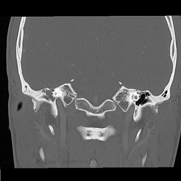 File:Acute otomastoiditis (Radiopaedia 28329-28575 Coronal bone window 13).jpg