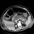 Acute pancreatic necrosis (Radiopaedia 13560-18502 Axial C+ portal venous phase 20).jpg