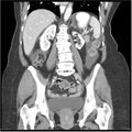 Acute pancreatitis (Radiopaedia 19136-19117 Coronal C+ portal venous phase 26).jpg