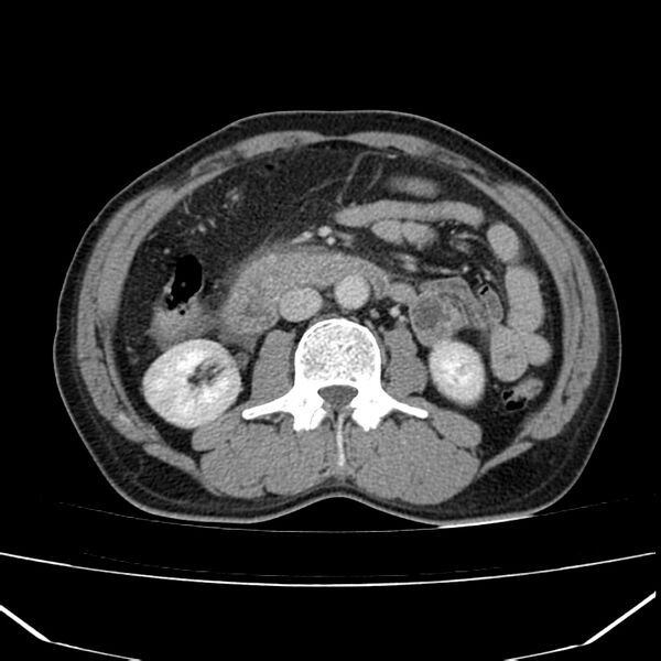 File:Acute pancreatitis (Radiopaedia 22572-22596 Axial C+ portal venous phase 35).jpg