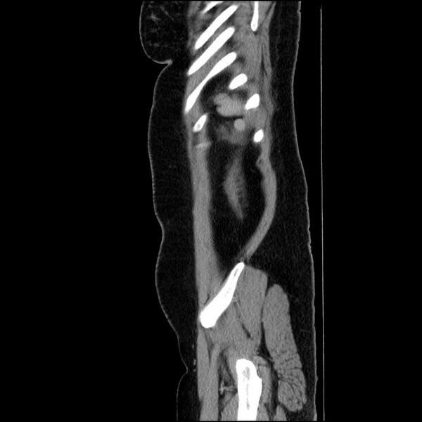 File:Acute pancreatitis (Radiopaedia 69236-79012 Sagittal C+ portal venous phase 21).jpg