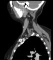Acute parotitis (Radiopaedia 27425-27619 Sagittal C+ portal venous phase 44).png