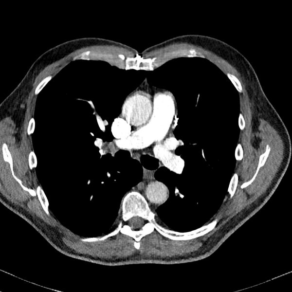 File:Acute pulmonary embolism (Radiopaedia 81677-95570 Axial C+ CTPA 37).jpg