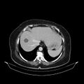 Acute pyelonephritis (Radiopaedia 25657-25837 Axial renal parenchymal phase 14).jpg
