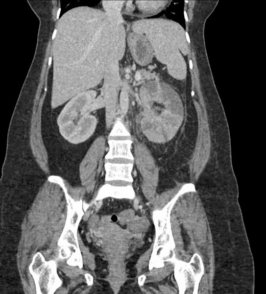 File:Acute pyelonephritis with renal vein thrombosis (Radiopaedia 58020-65053 Coronal renal parenchymal phase 50).jpg