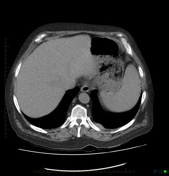 File:Acute renal failure post IV contrast injection- CT findings (Radiopaedia 47815-52557 Axial non-contrast 13).jpg