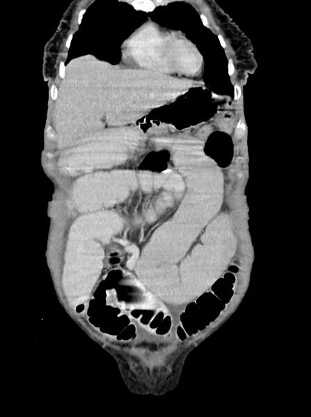 File:Acute small bowel (ileal) volvulus (Radiopaedia 71740-82139 Coronal C+ portal venous phase 25).jpg