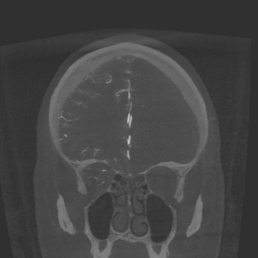 Acute subarachnoid hemorrhage and accessory anterior cerebral artery (Radiopaedia 69231-79010 Coronal arterial - MIP 26).jpg