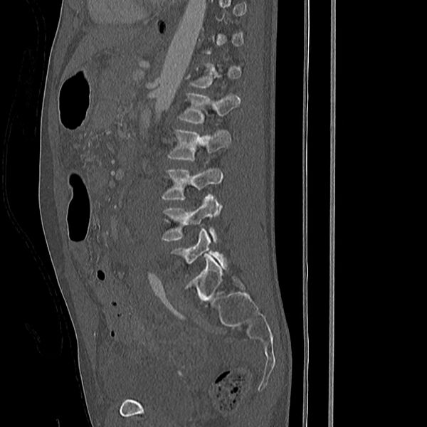 File:Acute vertebral body compression fractures (Radiopaedia 31757-32693 Sagittal bone window 15).jpg