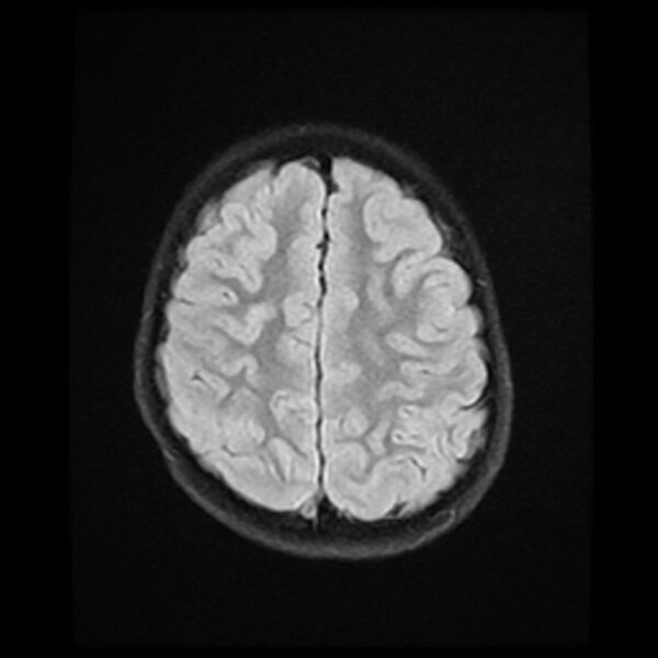 File:Adamantinomatous craniopharyngioma (Radiopaedia 77407-89529 Axial FLAIR 20).jpg