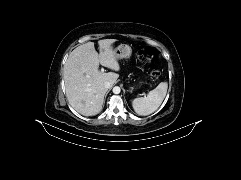 File:Adenocarcinoma of pancreas with hepatic metastasis (Radiopaedia 64332-73122 Axial C+ portal venous phase 26).jpg