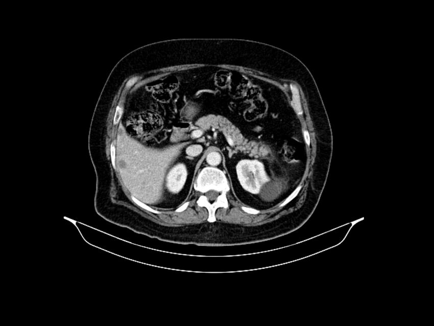 Adenocarcinoma of pancreas with hepatic metastasis (Radiopaedia 64332-73122 Axial C+ portal venous phase 34).jpg