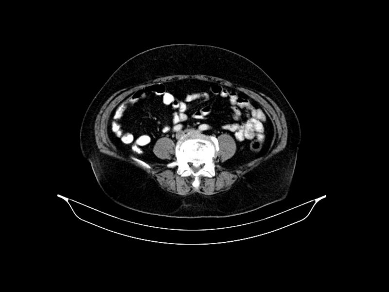 File:Adenocarcinoma of pancreas with hepatic metastasis (Radiopaedia 64332-73122 Axial C+ portal venous phase 68).jpg