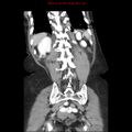 Adenocarcinoma of the colon (Radiopaedia 8191-9039 Coronal liver window 38).jpg