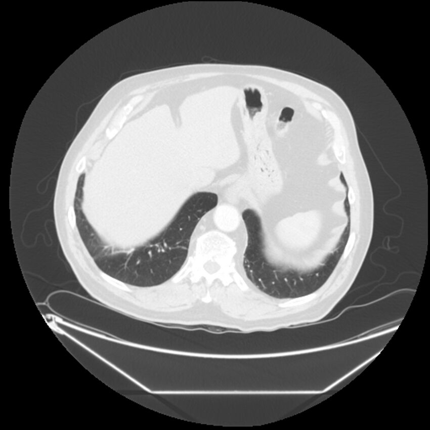 Adenocarcinoma of the lung (Radiopaedia 44876-48759 Axial lung window 69).jpg