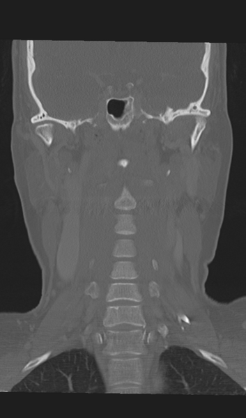 File:Adenoid cystic tumor of palate (Radiopaedia 46980-51518 Coronal bone window 37).png
