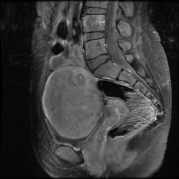 File:Adenomyosis on MRI (Radiopaedia 29328-29780 Sagittal T1 C+ fat sat 8).jpg