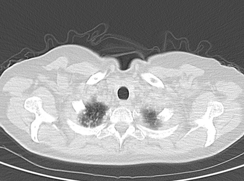 File:Adenosquamous lung carcinoma (Radiopaedia 22035-22030 lung window 13).jpg