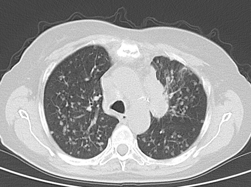 File:Adenosquamous lung carcinoma (Radiopaedia 22035-22030 lung window 25).jpg