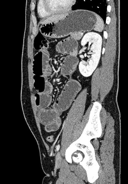 File:Adhesional small bowel obstruction (Radiopaedia 58900-66131 Sagittal C+ portal venous phase 174).jpg