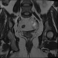 Adnexal multilocular cyst (O-RADS US 3- O-RADS MRI 3) (Radiopaedia 87426-103754 Coronal T2 20).jpg