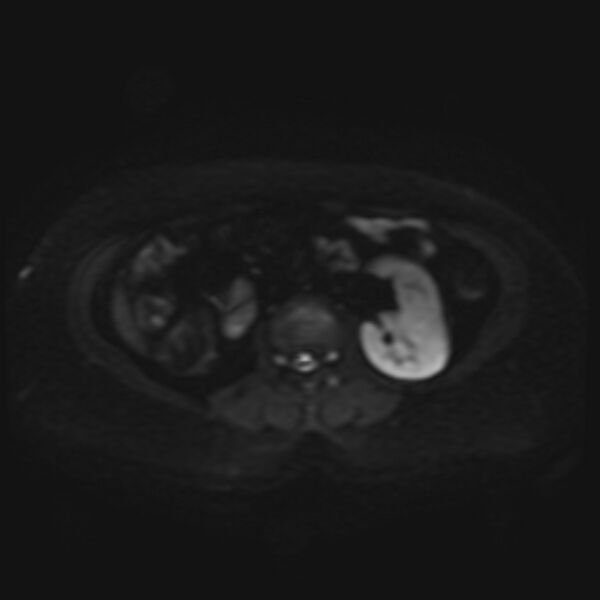 File:Adrenal cortical carcinoma (Radiopaedia 70906-81116 Axial DWI 20).jpg