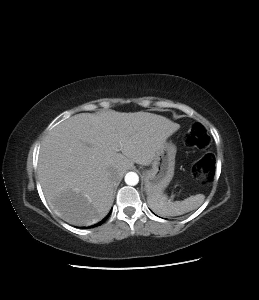 Adrenal cortical carcinoma with IVC invasion and thrombosis (Radiopaedia 34307-35597 Axial C+ arterial phase 16).jpg