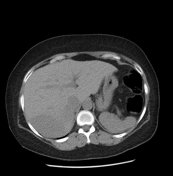 File:Adrenal cortical carcinoma with IVC invasion and thrombosis (Radiopaedia 34307-35597 Axial non-contrast 8).jpg