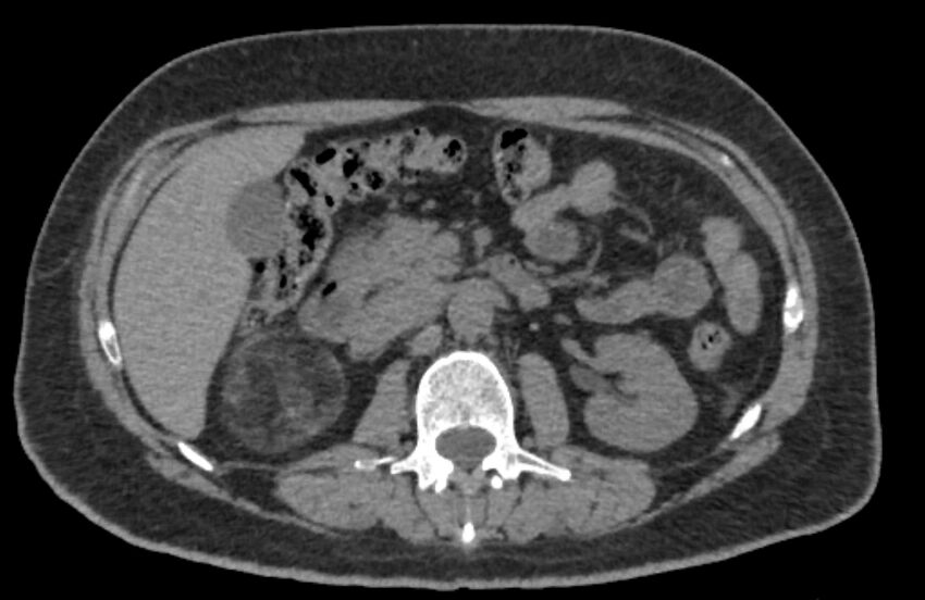 Adrenal myelolipoma (Radiopaedia 65240-74253 Axial non-contrast 55).jpg