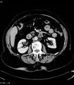 Adrenal myelolipoma (Radiopaedia 6765-7960 Axial C+ arterial phase 16).jpg