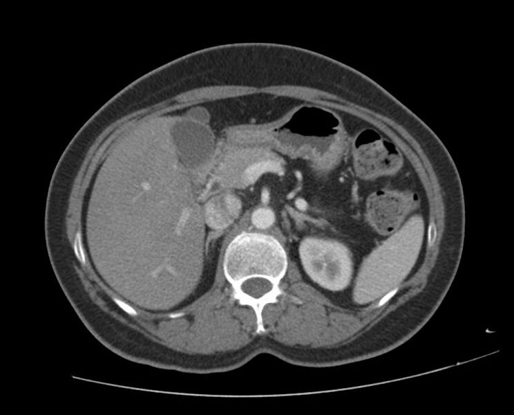 File:Agenesis of the dorsal pancreas (Radiopaedia 11180-11545 C 1).jpg