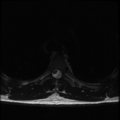 Aggressive vertebral hemangioma (Radiopaedia 39937-42404 Axial T2 30).png