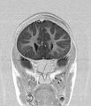 Aicardi syndrome (Radiopaedia 66029-75205 Coronal T1-IR 7).jpg