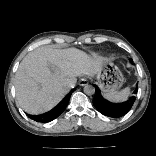 File:Airway foreign body in adult (Radiopaedia 85907-101779 Axial liver window 174).jpg