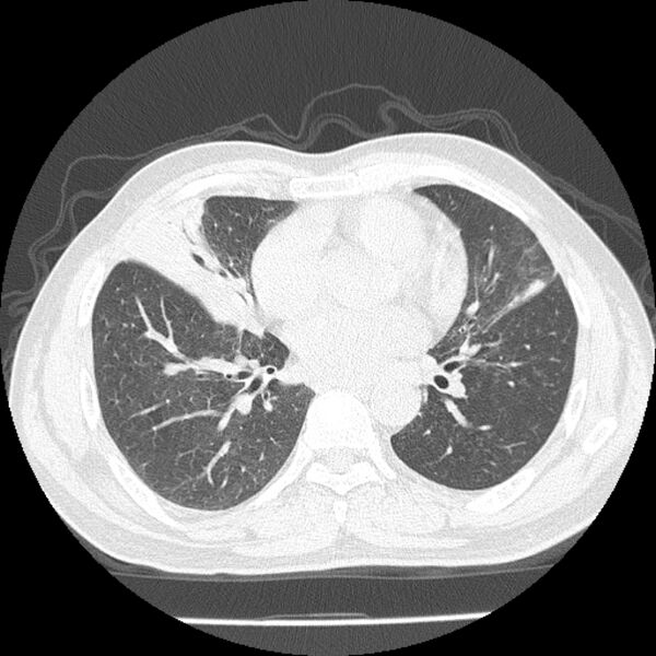 File:Airway foreign body in adult (Radiopaedia 85907-101779 Axial lung window 109).jpg