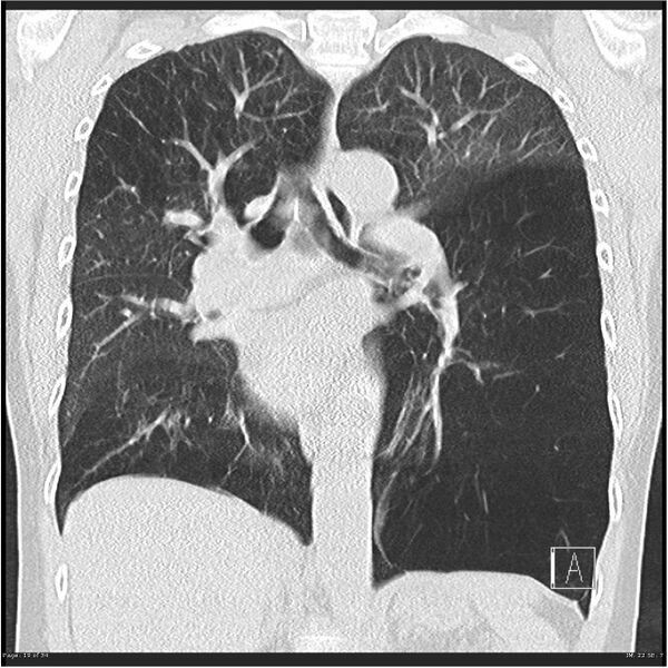 File:Alpha-1-antitrypsin deficiency (Radiopaedia 26537-26678 Coronal lung window 19).jpg