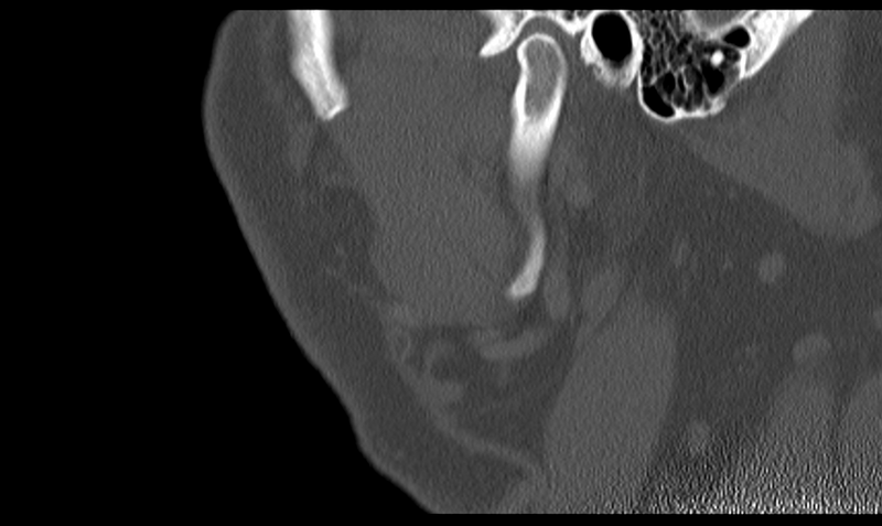 File:Ameloblastoma (Radiopaedia 33677-34806 Sagittal bone window 51).png