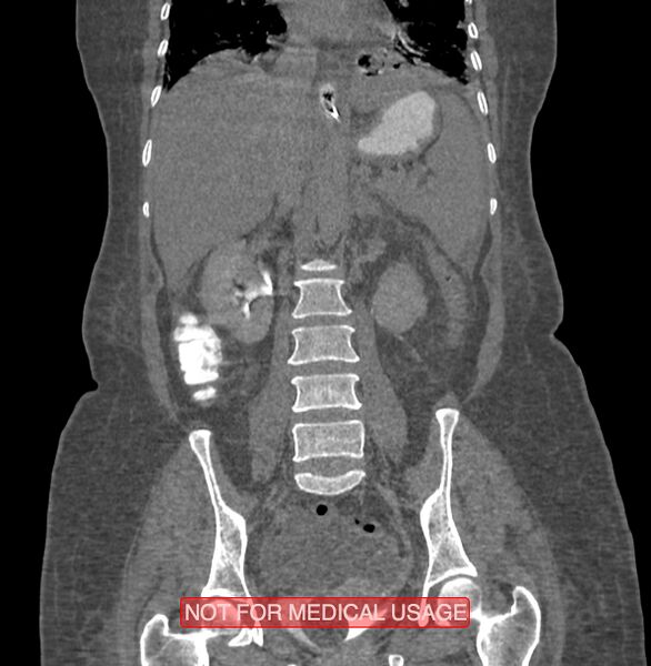 File:Amoebic enterocolitis with liver abscess (Radiopaedia 35100-36609 B 122).jpg