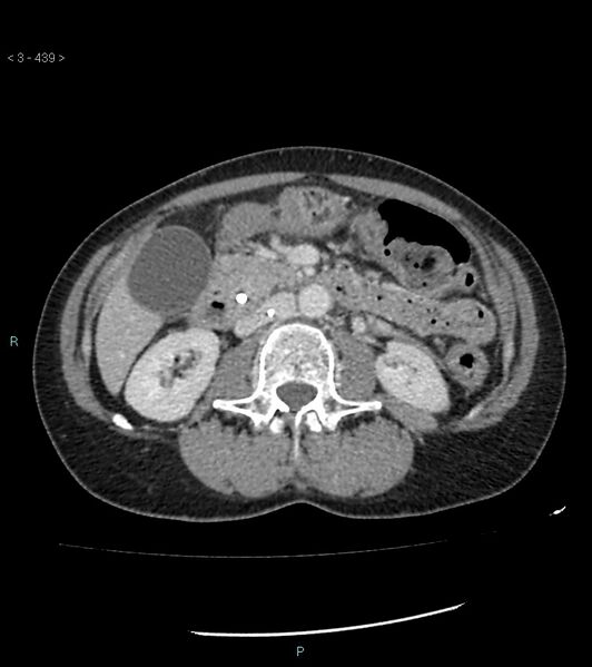 File:Ampulla of Vater metastasis (Radiopaedia 27820-28069 A 77).jpg
