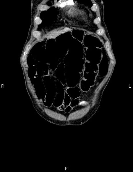 File:Ampullary adenocarcinoma (Radiopaedia 86093-102032 C 4).jpg