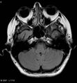 Amyotrophic lateral sclerosis (Radiopaedia 5373-7134 Axial FLAIR 6).jpg