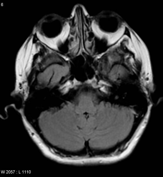 File:Amyotrophic lateral sclerosis (Radiopaedia 5373-7134 Axial FLAIR 6).jpg