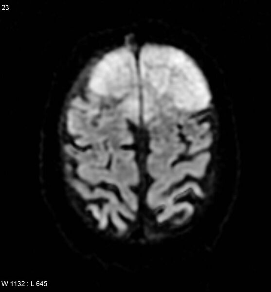 File:Anaplastic meningioma (Radiopaedia 5553-7290 Axial DWI 1).jpg