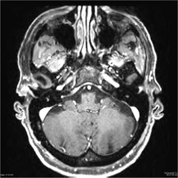 File:Anaplastic meningioma with recurrence (Radiopaedia 34452-35788 Axial T1 C+ 27).jpg