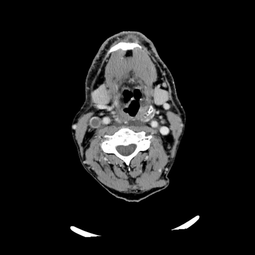 Anaplastic thyroid carcinoma (Radiopaedia 79087-92034 B 74).jpg
