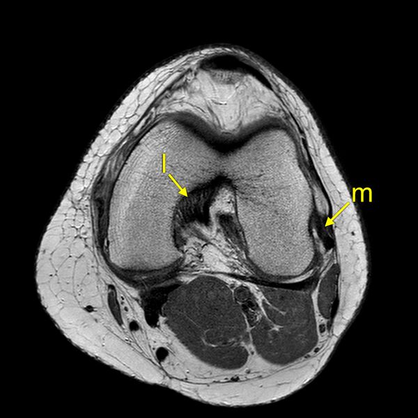 File:Anatomy Quiz (MRI knee) (Radiopaedia 43478-46866 A 14).jpeg