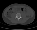 Aneurysmal bone cyst of ischium (Radiopaedia 25957-26094 Axial bone window 1).png