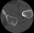 Aneurysmal bone cyst of ischium (Radiopaedia 25957-26094 B 40).png
