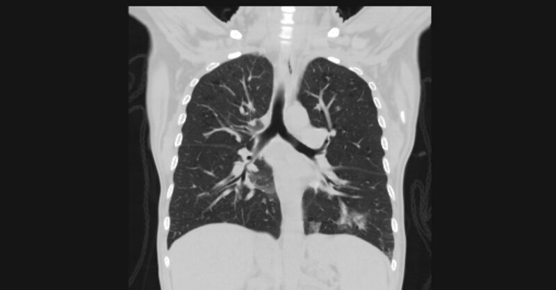 File:Angioinvasive aspergellosis (Radiopaedia 66995-76315 Coronal lung window 36).jpg